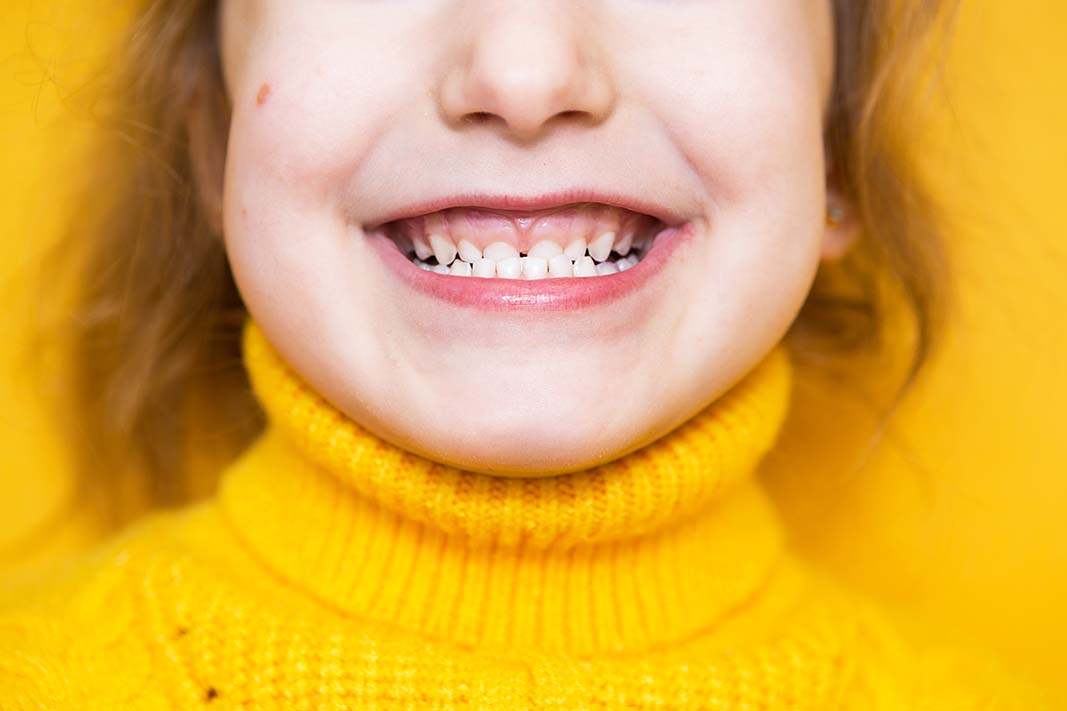 Young girl in bright yellow sweater who's bottom teeth jet out in front of her upper teeth as an underbite.