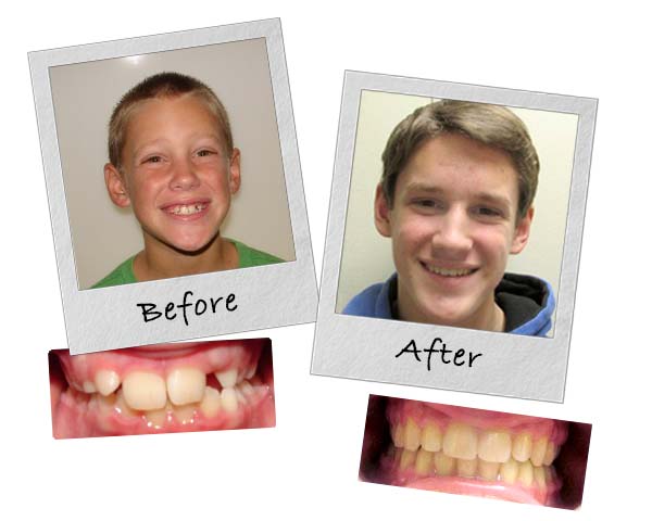 Invisalign before and after picture of a Lippitz Orthodontics patient