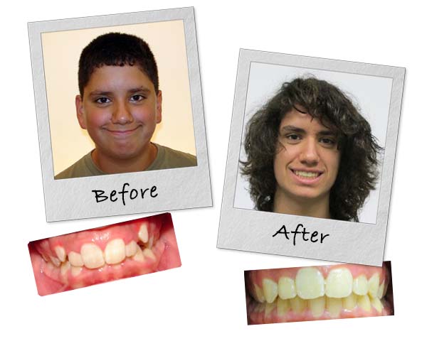 An Invisalign patient in Bannockburn showing off his smile before and after straightening his teeth with Invisalign.
