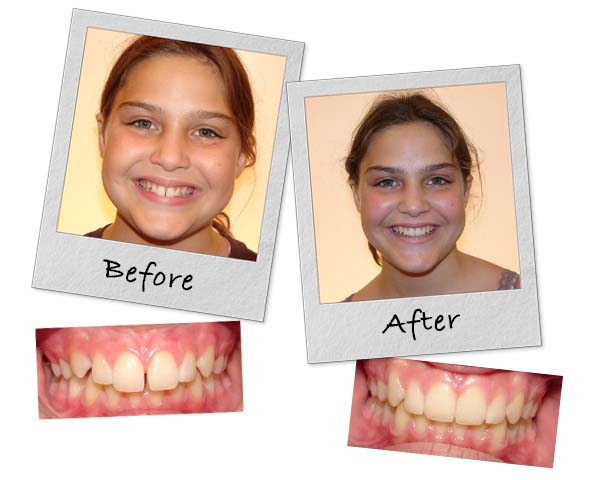 Before and after smile pictures of a patient from Lippitz Orthodontics near Chicago