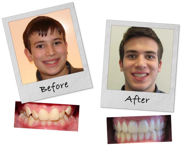 Before and after smile images of a young man who saw Dr. Lippitz at Lippitz Orthodontics near Bannockburn