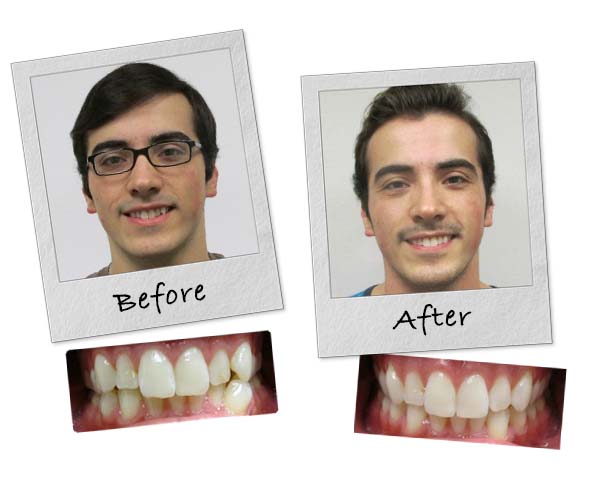 One of Dr. Lippitz's patients who had Invisalign and is now showing off his before and after smile photos