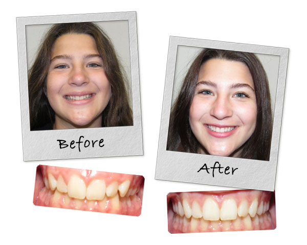 Lakeview, Chicago patient showing off her perfect smile and what her smile used to look like before she straightened her teeth.