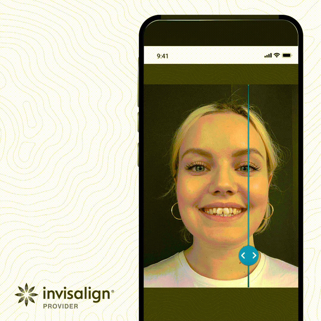 See your new smile with Invisalign's SmileView simulation tool