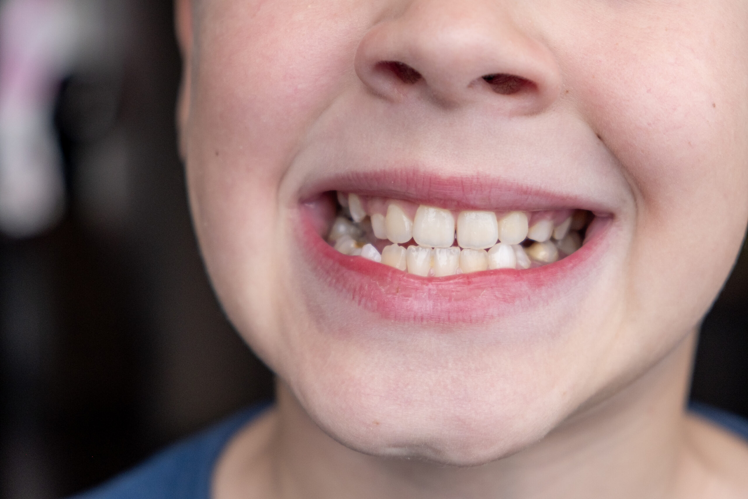 Young man showing crooked teeth, illustrating common dental issues like crossbites in kids.