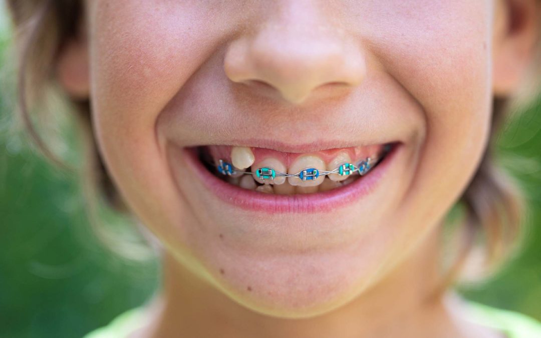 What Your Braces Rubber Band Color Says About You