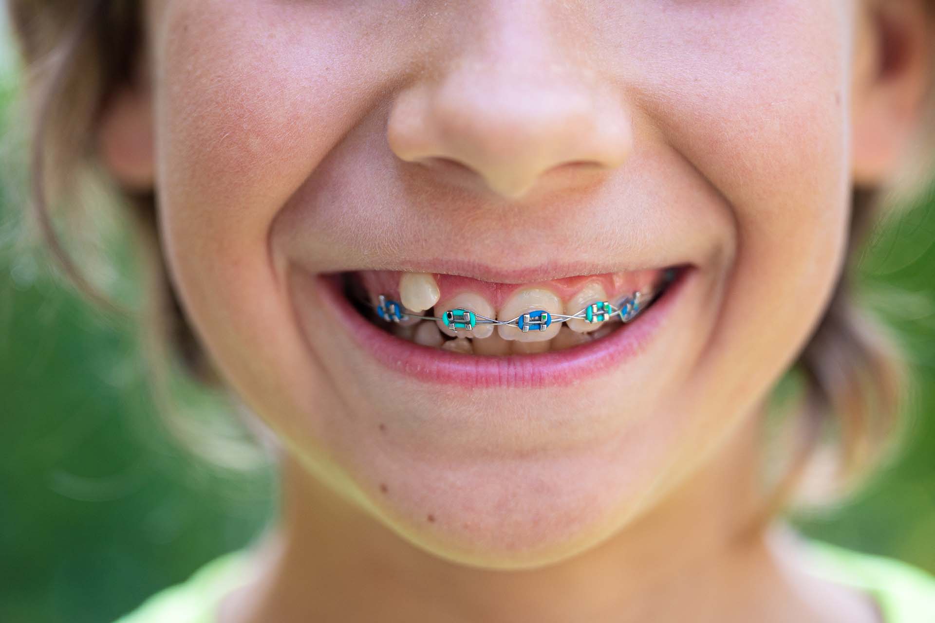 Child with colored rubber bands on braces