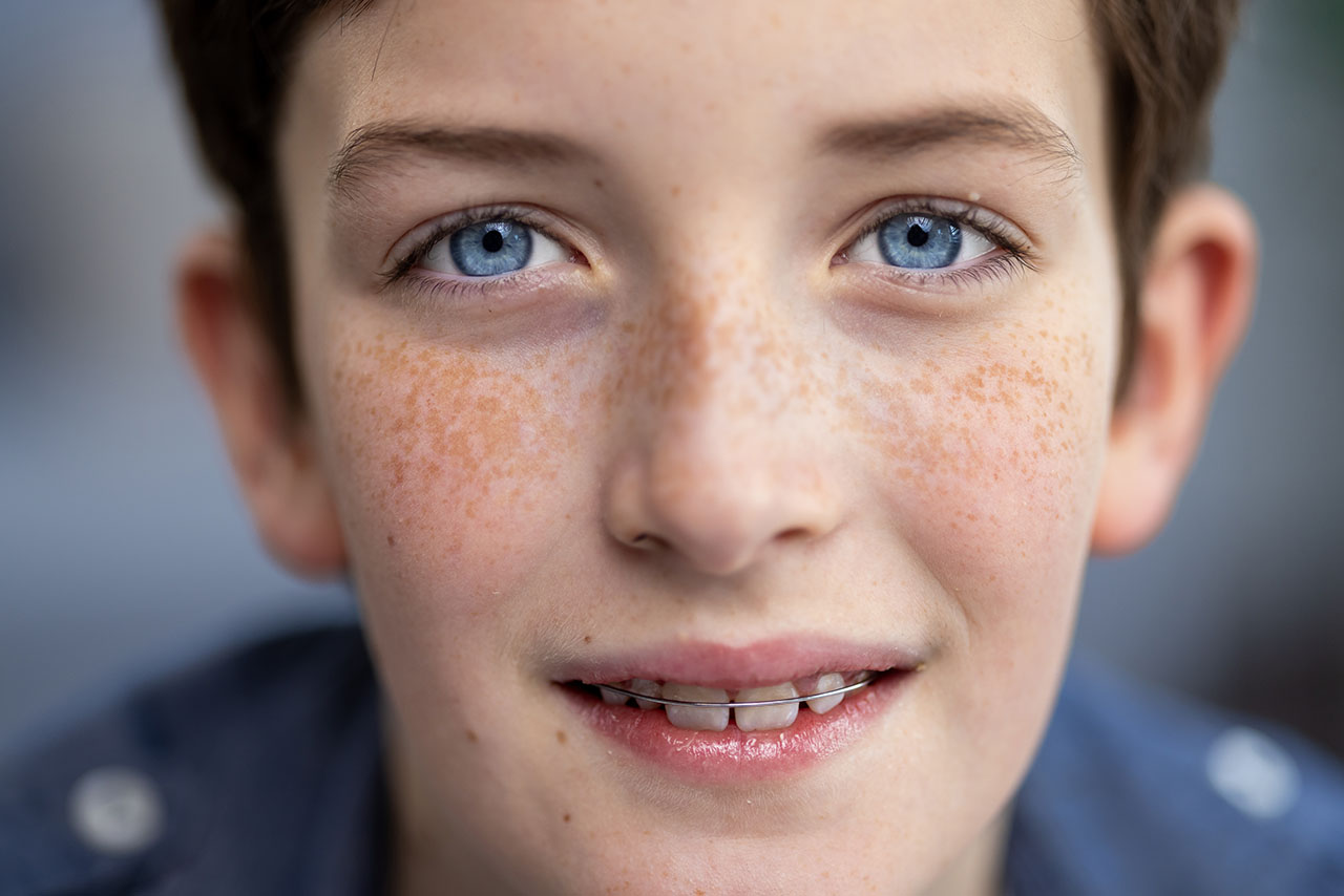 Teenage boy smiling confidently, showing his Hawley retainer. A common type of orthodontic retainer used after braces.